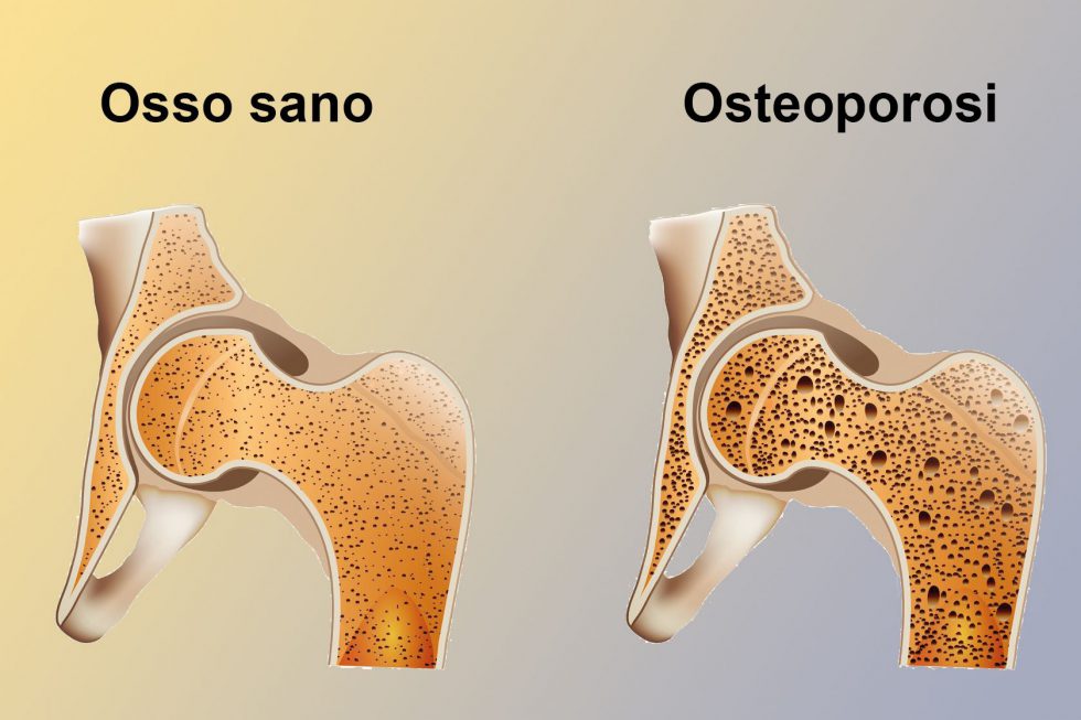 Osteoporosi dr cristina tomasi